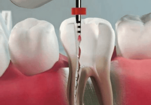 Endodontia - Tratamento de Canal